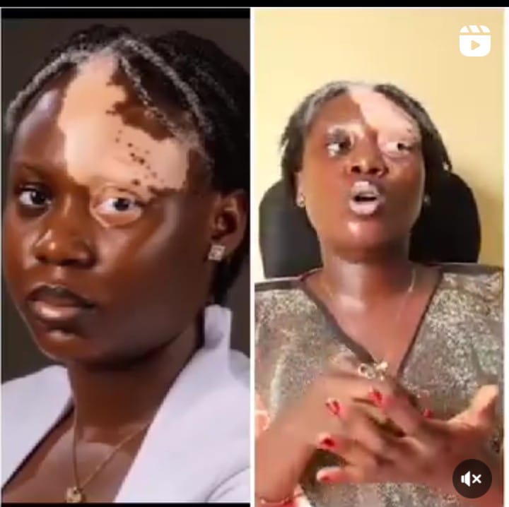 Living With Vitiligo: Lady criesOut Against Stigma and Discrimination